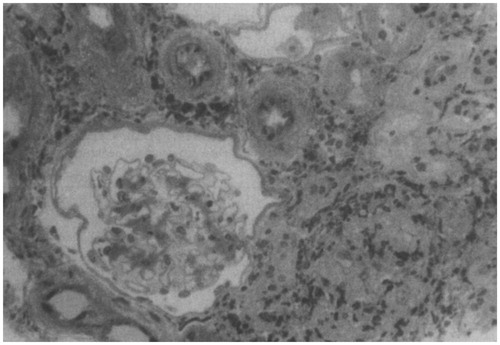 Figure 2. Renal biopsy done in a woman with arsenic poisoning and tubulointerstitial nephritis. Biopsy specimen showing a normal glomerulus, extensive interstitial fibrosis with tubular atrophy, and a cellular infiltrate consisting mainly of lymphocytes (Adapted from reference Prasad and Rossi).Citation61