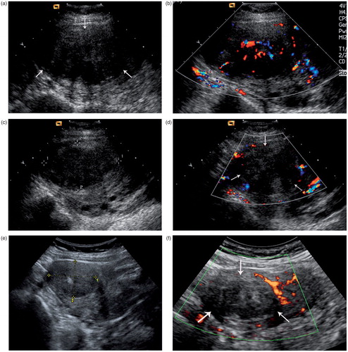 Figure 1. Ultrasound images in a 47-year-old woman with uterine myoma before and after microwave ablation therapy. (a) Sonogram obtained before microwave ablation shows a 7.0 × 5.7-cm uterine myoma (arrows) in uterine. (b) Colour Doppler Flow Image obtained before microwave ablation depicts the rich blood flow in the myoma. (c) Sonogram obtained 1 day after ablation shows that the myoma (arrows) has become heterogeneously hyperechoic; the size of the treated myoma is about 6.8 × 4.2 × 4.6 cm. (d) On a Colour Doppler Flow Image obtained 1 day after ablation, no blood signal is detected in the treated region (arrows). (e) Sonogram obtained 1 year after ablation shows that the myoma (arrows) has shrinked remarkably, and the size of the treated myoma is about 4.5 × 3.7 cm. (f) Power Doppler Flow Image obtained 1 year after microwave ablation depicts no blood signal in the myoma. (g) Contrast-enhanced sonogram obtained 1 day after ablation shows no contrast agent in the myoma, suggesting the complete necrosis of myomas (sagittal view). (h) Contrast-enhanced sonogram obtained 1 day after ablation shows no contrast agent in the myoma, suggesting the complete necrosis of myomas (transverse view).