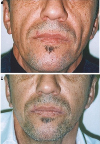 Figure 5 Subject 5 before treatment (A) and 15 months (B) after injection of CPM HA volumizing gel.