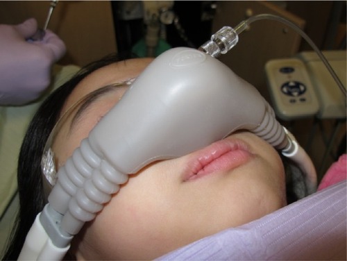 Figure 1 Nitrous oxide nasal hood modified for use with an end-tidal carbon dioxide sampling line.
