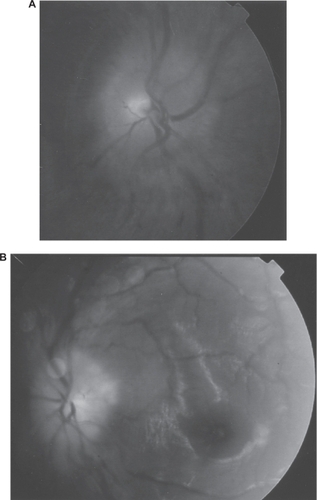 Figure 3 Significant decrease of papilledema three days following ONSF and placement of lumbar drain; A, right eye; B, left eye.