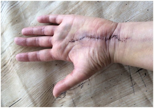 Figure 4. Two weeks post-operative showing the chosen incision.