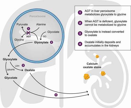 Figure 1. Consequences of the block (X) in glyoxylate metabolism when AGT is deficient