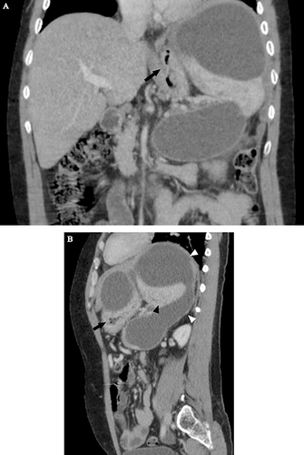 Figure 2 Coronal (A) and sagittal (B) views of the portal venous phase revealed a large (18.4 cm x 17.7 cm x 12 cm) thin-walled, lobulated, and trans-spatial lesion (white arrowheads in B). It did not show any internal enhancement, mural nodularity, septations, or signs of local organ invasion. As it extended posterosuperiorly to the left subdiaphragmatic space, the lesion assumed a C-configuration. It pushed the spleen inferiorly (black arrowhead in B) and squeezed the stomach (black arrow in A and B).