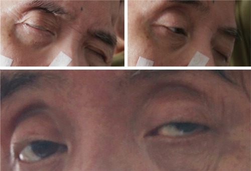 Figure 3 Stroke patient’s ability to respond to object from opening his eyes from slim (top left) to moderate (top right) and to full openings (bottom). This took place gradually from the task onset and during early stage of the training session.