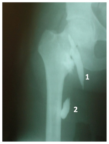 Figure 2 The spread of contrast in combined continuous femoral and sciatic nerve block.Notes: 1 is the spread of contrast in the continuous femoral nerve block; 2 is the spread of contrast in the continuous sciatic nerve block.