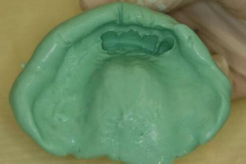 Figure 8 Maxillary irreversible hydrocolloid impression.