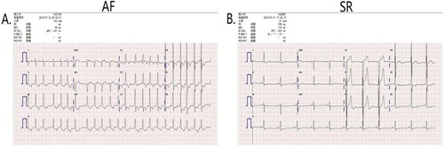 Figure 1. Representative the Preoperative electrocardiogram of AF patients and SR patients. Representative the Preoperative electrocardiogram of AF(A) patients and SR(B) patients. AF: atrial fibrillation; SR: sinus rhythm.