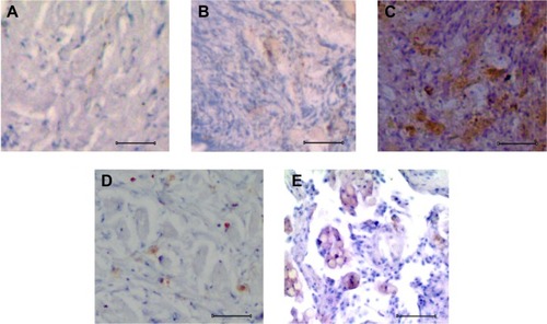 Figure 2 Analysis of Sox2 expression in normal and osteosarcoma tissues.