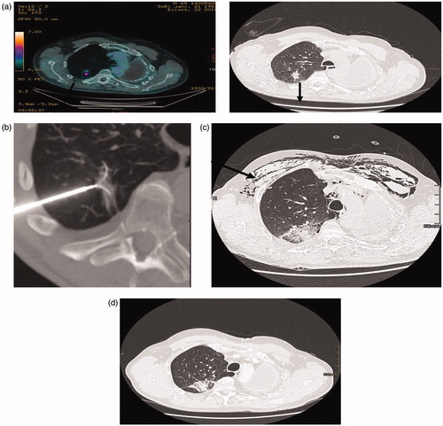 Figure 1. (a) (PET-CT, CT): patient 72 year old, previously treated for an NSCLC by pneumonectomy, 4 years later an adenocarcinoma of the upper right lobe was treated with SBRT recurrence 16 months after SBRT (black arrow). (b) RFA treatment under general anesthesia with a 3.5 cm expandable electrode. (c) CT two days after RFA: the ablation zone encompasses the tumoral volume, subcutaneous emphysema, pneumothorax drained (black arrow). (d) CT 3 months after RFA showing a good result, the ablation zone encompassing the tumor.