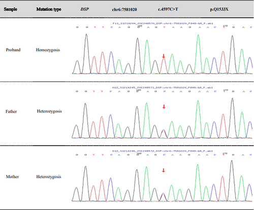 Figure 3 Variant analysis in the proband and her parents. Both the parents carried a heterozygous variant c.4597C > T (p.Q1533X) in DSP gene; Proband disclosed a homozygous missense variant c.4597C > T (p.Q1533X) in exon 6 of DSP gene.