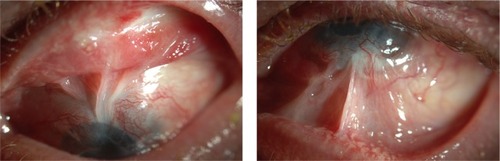 Figure 1 Forniceal scarring documented in a patient during a preoperative evaluation for keratoprosthesis.