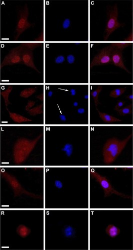 Figure 6 Fluorescent microscopy.Notes: Images of B16F10 cells treated for 72 hours with PBS (A, B, and C), ND (200 μg/mL) (D, E, and F), ND + C (200 μg/mL) (G, H, and I for low magnification; L, M, and N for high magnification), C (640 μM) (O, P, and Q), and PHL (R, S, and T). In cells, β-actin distribution, shown in red (A, D, G, L, O, and R) and DNA localization, stained in blue with DAPI (B, E, H, M, P, and S) are shown. The merging images of the two signals are also shown (C, F, I, N, Q, and T). White arrows point to pro-metaphasic nuclei in (ND + C)-treated cells (H, low magnification). The white bars indicate 15 μm.Abbreviations: PBS, phosphate-buffered saline; ND, nanodiamond; C, citropten; PHL, phalloidin; DAPI, 4′,6-diamidino-2-phenylindole dihydrochloride.