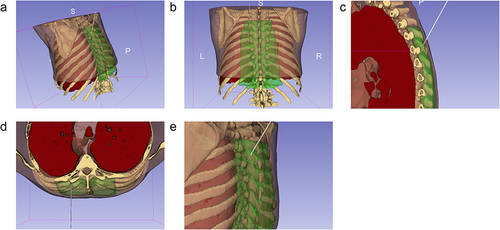 Figure 1 Needle placement for the erector spinae block at the level of T6 on the left, with the needle represented in grey, erector spinae muscles in green, lung in red, thoracic vertebrae and ribs in white, and the thorax in pink. Views presented are (a) posterior view from the left, (b) posterior view, (c) sagittal transection viewed from the left, (d) axial transection viewed from above, and (e) a view of the needle with the patient upright. All images created using 3D slicer (version 5.2.2, 2023) an open-source software, with the segments created using a sample CT chest dataset.
