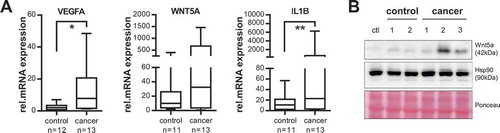 Figure 6. Cancer-patient-derived MV induce a tumour-supporting phenotype in human macrophages. (a) Human macrophages were stimulated with MV isolated from cancer or control patients (50 µg/ml) for 24 h and gene expression of VEGFA, WNT5A and IL1B was measured by qRT-PCR (n = 4, *p = 0.004, **p = 0.041 with two-sided t test). Expression changes were calculated relative to unstimulated macrophages. Box plots illustrate the 25–75 percentiles (boxes), the 10–90 percentiles (whiskers) and the median (line). (b) Representative western blot of four independent experiments: Wnt5a expression in unstimulated macrophages (ctl) and after incubation with MV (50 µg/ml, 24 h) from cancer and control patients. Hsp90 and Ponceau staining are shown as loading controls.