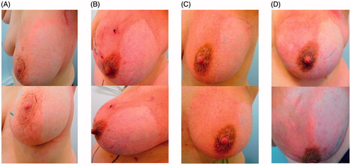 Figure 2. Exemplary photographs, taken from two different angles, of four (A–D) different patients following completion of the radiation therapy. In these patients, Hydrofilm was applied to the lateral breast compartment during the entire radiation therapy period.