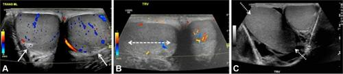 Figure 3 Testicular lie—normal and abnormal. (A) Color Doppler transverse US image of the testes in a 12-year-old boy with mild groin pain demonstrates normal vertical lie with the testes seen in round cross-section and with the mediastinum testis (arrows) directed posterolaterally. (B) Color Doppler transverse US image of both testes in a 14-year-old boy who woke with acute right scrotal pain demonstrates abnormal horizontal lie of the right testis (arrow) with slightly decreased intratesticular flow compared to the normal left side. He had experienced similar episodes of pain in the past and was diagnosed with intermittent torsion. During orchiopexy 12 h later, a bell clapper deformity was noted bilaterally. (C) Gray-scale transverse US image of both testes in a 16-year-old boy with right testicular pain demonstrates abnormal oblique lie of the right testis (arrows), which is oriented diagonally compared to the normal left side. Intermittent torsion was diagnosed intraoperatively. (Image obtained from Bandarkar AN, Blask AR. Testicular torsion with preserved flow: key sonographic features and value-added approach to diagnosis. Pediatr Radiol. 2018;48(5):735–744. doi:10.1007/s00247-018-4093-0.Citation27 Distributed under the terms of the Creative Commons Attribution 4.0 International License (http://creativecommons.org/licenses/by/4.0/). No changes have been made to the images or the image description).