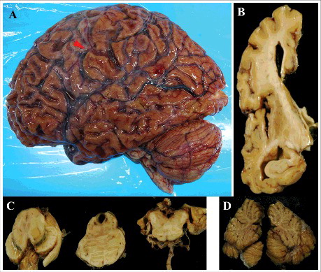 Figure 1. Macroscopic findings in patient 5. (A) the lateral aspect of the left cerebral hemisphere. The arrowhead indicates the central sulcus. (B) the left coronal section of the frontotemporal lobe through the anterior commissure from the posterior side. (C) the horizontal cut surface of the brainstem, from the left to the midbrain, pons, and medulla oblongata. (D) the sagittal division plane of the cerebellar vermis.
