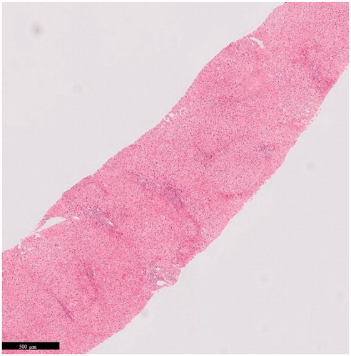 Figure 5. Microscopic examination of a liver biopsy with nodular regenerative hyperplasia (NRH). Histopathology of a liver biopsy with NRH characterized by nodules of hypertrophic hepatocytes surrounded by a rim of atrophic liver plates with compression of sinusoids in a patient with inflammatory bowel disease treated with thioguanine without signs of (non-cirrhotic) portal hypertension (Hematoxylin-Eosin stained).
