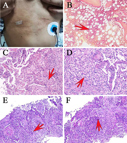 Figure 1 Exclusion of the proliferative neoplasms and indication the existence of infection by biopsy. (A) Body rashes were observed during physical examination on admission. Multiple rufous body rashes with central umbilication were scattered in the thoracoabdominal skin of the patient. (B) Nucleated cells in bone marrow smears showed normal blood picture of the patients with marked hyperplasia of active proliferation of erythroid, myeloid and megakaryocytes. (C and D) Histologic section of the mucosae from the pulmonary solid mass in the right upper lobe showed chronic active inflammation with organic consolidation. (E and F) Histologic section of the pulmonary solid mass in the right upper lobe showed multifocal areas of consolidation with fibrous polypoid tissue, alveolar epithelium and vascular hyperplasia in the alveolar cavity. A large number of lymphocytes, plasma cells, phagocytes and neutrophils were infiltrated in the lung tissue, and the pulmonary septum was widened, which suggested that chronic active inflammation of lung tissue with parenchymal lesions and bronchiolitis obliterans with organized pneumonia (BOOP). (B–F) The red arrow indicates the inflammatory infiltration area.