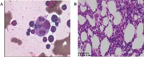Figure 1. Hematoxylin and eosin stain (HE) of bone marrow aspirate smear (left anterior superior iliac spine) showed the evidence of hemophagocytosis, Macrophage engulfing erythrocytes, platelets, and neutrophils; original magnification ×400 (A). Bone marrow pathology: bone marrow hyperplasia is generally normal, three lines of hematopoietic cells can be seen, with lobulated megakaryocytes and no tumor cells, original magnification ×40 (B).