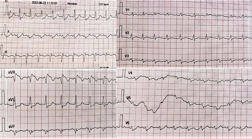 Figure 1 McGinn-White sign: Q-wave in DIII, and an inverted T-wave in derivative DIII.
