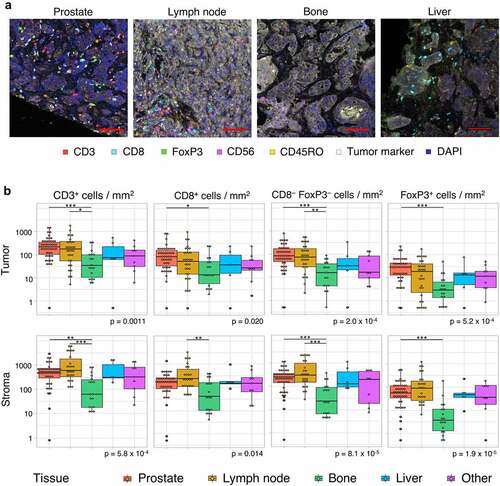 Figure 2. Tumor-infiltrating lymphocyte density per tissue site. A. Multiplex immunohistochemistry (IHC) images of the four most prevalent tissue sites (≥ 5 samples included). The scalebar represents a length of 100 µm. Additional representative IHC images are shown in supplementary figure 3. B. CD3+, CD8+, CD3+CD8−FoxP3− and FoxP3+ cell density in the tumor (upper panel) and stroma compartment (lower panel) per tissue site. For all cell subsets, we observed significant differences between tissue sites, both in the stromal and tumoral compartments (Kruskal-Wallis test, p ≤ .05). Black lines indicate significant differences between pairs (Dunn’s test, * p ≤ .05; ** p ≤ .01; *** p ≤ .001). In some patients, no T cells were present. To enable visualization of cell densities on a log scale, the T cell densities of these patients were replaced by 0.5 cells/mm2 (~lowest value in the plots). Differences between paired samples are displayed in supplementary figure 4.