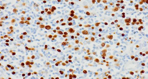 Figure 6 HE immunohistochemical staining (magnification 400x). The stains included anti-CD20, CD3, CD30, CD15, PAX5, MUM-1, Ki-67.