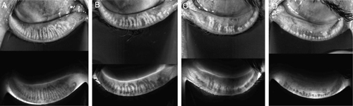 Figure 1 Representative meiboscore images for grades 0–3.