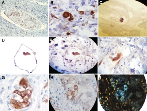 Figure 7 Neuron-specific enolase immunostaining analysis. A shows neuron-specific enolase immunostaining of control tissue from a peripheral nerve (10×); B reveals highly selective enolase immunopositivity in aligned fractal embryoid body structures from a case of esophageal squamous cell carcinoma (40×); C is a panoramic view revealing highly selective enolase immunopositivity in a self-assembled fractal embryoid body structure aligned into a hexagonal geometric pattern from a case of skin squamous cell carcinoma (10×); D is a detachment subimage of E, which shows highly selective enolase immunopositivity in a self-assembled embryoid body structure inside a hexagonal geometric pattern in a case of lung carcinoma (10×); F is a micrograph demonstrating highly selective enolase immunopositivity in a well-defined self-assembled embryoid body pattern in a case of undifferentiated lung cancer (20×); G is a micrograph revealing high enolase immunopositivity in a well-defined self-assembled embryoid body pattern from a case of prostate carcinoma (40×); H is a micrograph revealing enolase immunopositivity in a well-defined, self-assembled embryoid body pattern in a case of squamous cell carcinoma of the skin (10×); and I is a negative image of H.