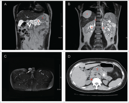 Figure 1. Imaging findings of 2 patients. (A) and (B) Abdomen magnetic resonance (MR) of the brother (II:1) showed a solid lesion (1) and multiple cysts (2) in the pancreas; liver vascular lesion located in the S7/8 section (3); solid lesions (4) and multilocular renal cysts (5) in the kidney; and a right adrenal nodule (6). (C) Scrotum magnetic resonance (MR) of the brother (II:1) showed a malignant tumor in the right side epididymis (arrow). (D) Abdomen computed tomography (CT) of the sister (II:6) showed multiple cysts in the pancreas (7) and a right adrenal nodule (8).