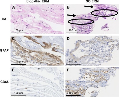 Figure 1 Microscopic images of H&E staining and IHC staining of an idiopathic ERM and an SO ERM.