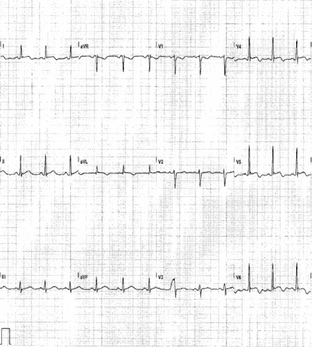 Figure 1 First cardiac event.