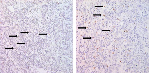 Figure 2. FOXP3 immunohisochemical staining. Intracelluar nuclear stainings (black arrows) indicate positive FOXP3 lymphocytes in peritumoral area underling invasive ductal carcinoma background (× 400).