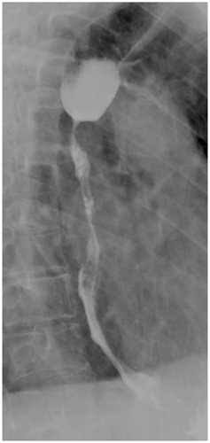 Figure 2. Radiograph with water-soluble contrast one day after POEM procedure. It demonstrates a stenosis proximal of the incision with a prestenotic dilation which is attributed to edema and spasm and caused severe dysphagia for the patient.