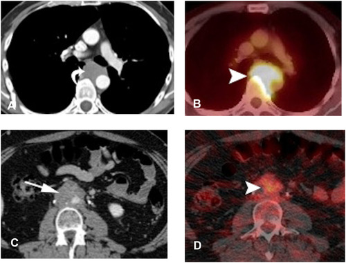 Figure 12 Use of FDG-PETCT in restaging. (A and B) Patient with seminoma showing mediastinal lymphadenopathy with increased FDG avidity. (C and D) Patient with NSGCT showing mildly hypermetabolic retroperitoneal lymph nodes. In both cases, FDG-PET/CT was used for treatment-response monitoring.