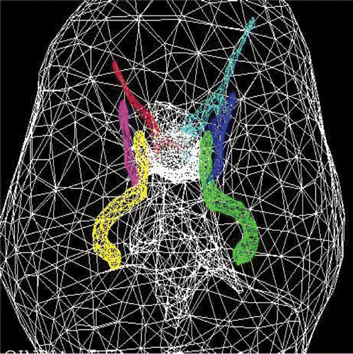 Figure 7. Clinically useful meshing: superposition of relevant critical tissue meshes with the brain surface. Basilar arteries and optic and oculomotor nerves are shown as triangular mesh. [Color version available online.]