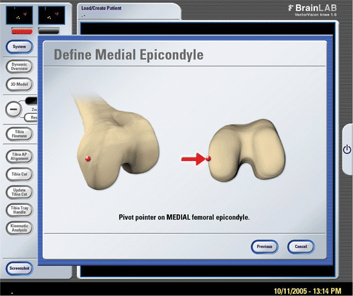 Figure 1. Screen of the navigation system during registration of the epicondyles of the femur. [Color version available online.]