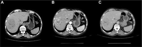 Figure 4 Contrast-enhanced computed tomography of abdomen showed a huge enhanced carcinoma in the liver.