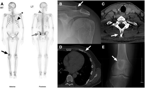 Figure 2. (A) Anterior and posterior whole-body planar images from a technetium-99m-methylene diphosphate (MDP) bone scan show increased tracer uptake secondary to hyperparathyroidism, at the left acromioclavicular joint (black asterisk), cervicothoracic junction (grey arrowhead), costochondral junctions bilaterally (black arrowhead), left iliac bone (grey arrow, biopsy-confirmed brown tumour) and right patellofemoral joint (black arrow). (B) Anteroposterior radiograph of the left shoulder showing osteolysis of the distal clavicle. (C) Axial CT of the spine showing a pathological fracture of the T1 spinous process, secondary to a brown tumour. (D) Axial CT through the chest showing an expansile lytic lesion of the anterior left 5th rib, in keeping with a brown tumour. The increased uptake on bone scan along the remaining costochondral junctions was non-specific. (E) Anteroposterior radiograph of the right knee showing a large lucent lesion in the patella, consistent with a brown tumour.