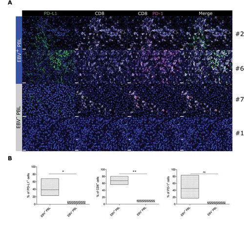 Figure 6. Multiplex immunofluorescence of CD8+ lymphoid infiltrates and PD-1/PD-L1 proteins in EBV+ and EBV− plasmablastic lymphomas.FFPE tissue sections of representative cases of EBV+ and EBV− PBL stained for PD-L1 (green), CD8 (white) and PD-1 (magenta). Figures represent 600x images of single PD-L1, single CD8, CD8/PD-1, and PD-1/PD-L1/CD8 staining. A typical image of PBL cases #2, #6 (EBV+ PBL) and PBL cases #7 and #1 (EBV− PBL) are shown. Hoechst nuclear counterstain (blue) (scale bar = 20 µm for all panels) (A). Floating bar graphs showing the quantification (%) of PD-L1, CD8 and PD-1 stainings in multiplex immunofluorescence. Unpaired Student’s t-test using the GraphPad Prism software (version 6; GraphPad) was used to determine the statistical signiﬁcance of differences between the groups (p = 0.0466, p = 0.0039 and p = 0.05, respectively) (B).