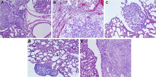 Figure 10 Pathomorphological changes of A549 tumor section in all the groups (×100).Notes: (A) Positive group, (B) combination group, (C) test group, (D) reference group, and (E) model group.