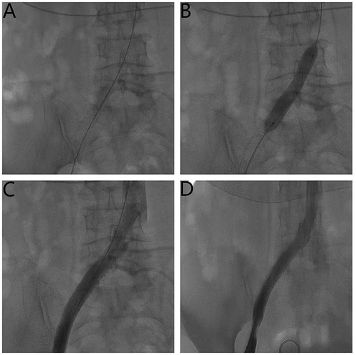 Figure 4 Radiographic image after stent implantation. (A) Common iliac vein implantation with bare stent. (B) Balloon dilation after stent implantation. (C and D) Angiography of iliac vein patency after stent implantation.