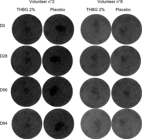 Figure 1 Melanin content visualization at D0 and after 14, 28, 56, and 84 days of placebo and THBG treatments (SIAscope™ tool, selection of two volunteers).