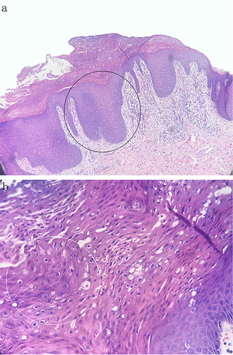 Figure 2 (a and b) The horny layer showed highly compact hyperkeratosis and parakeratosis with basophilic granules (white circle). The epidermis showed obvious acanthosis with psoriasiform hyperplasia (black circle). Lymphocytes had infiltrated around small vessels in the upper dermis. (HE, a x40; b x200).