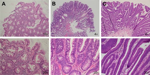 Figure 1 Photomicrographs (hematoxylin & eosin stain) of different types of colon polyps.