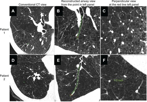 Figure 2 Comparison of conventional view of ultrahigh-resolution CT, reconstructed longitudinal airway view, and perpendicular image of airway axis in two patients with chronic obstructive pulmonary disease. (A–C) Patient 1 and (D–F) patient 2.Abbreviation: CT, computed tomography.