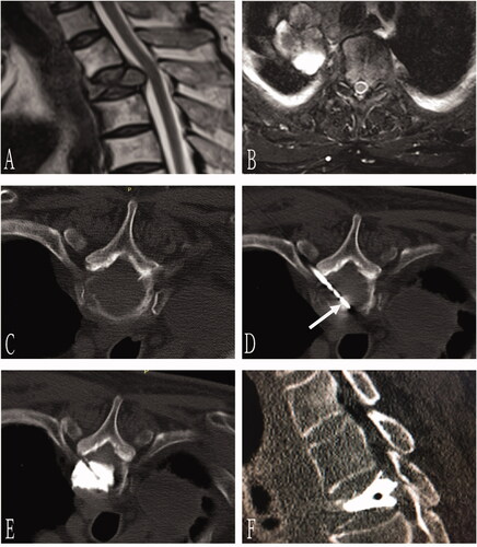 Figure 1. A 62-year-old man with painful osteolytic T3 metastases from lung adenocarcinoma was treated with microwave ablation combined with bone cementing. Preoperative sagittal MRI (A), axial MRI (B), and axial CT (C) revealed osteolytic T3 metastases with the complete destruction of the posterior vertebral wall, tumor compression of the dural sac, and severe compression fracture. Using the left costal joint approach, a microwave antenna (arrow) was guided to the anterior edge of the lesion (D) by a bone puncture needle (arrow). After microwave ablation, 3 ml of bone cement was injected slowly (E), and the sagittal CT showed that the bone cement was deposited in the lesion area without obvious leakage (F). CT: computed tomography; MRI: magnetic resonance imaging.