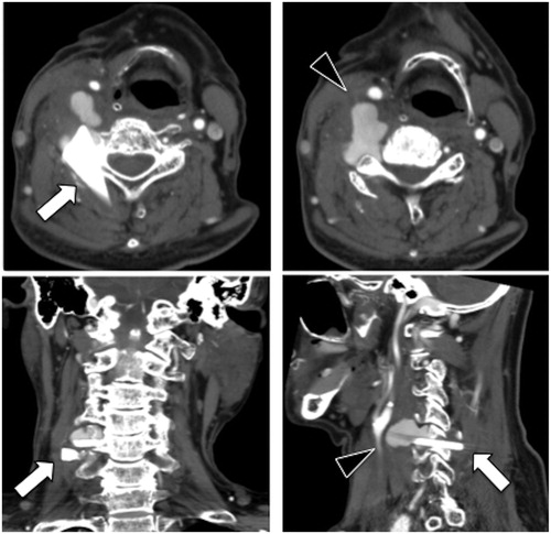 Figure 1. Contrast-enhanced computed tomography scan showing remnants of glass pieces in the neck (arrow) and the damaged right vertebral artery and pseudoaneurysm (arrow head).