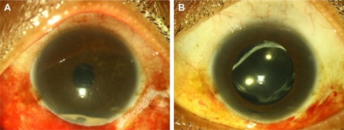 Figure 1 Clinical photograph of the left eye of case 2.